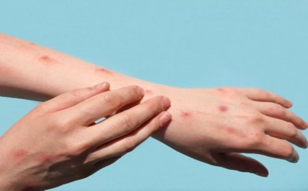 Alerta em Campo Grande: Sesau investiga caso suspeito de mpox e aguarda exames