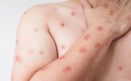 MS registra três casos suspeitos de mpox e SES monitora situação