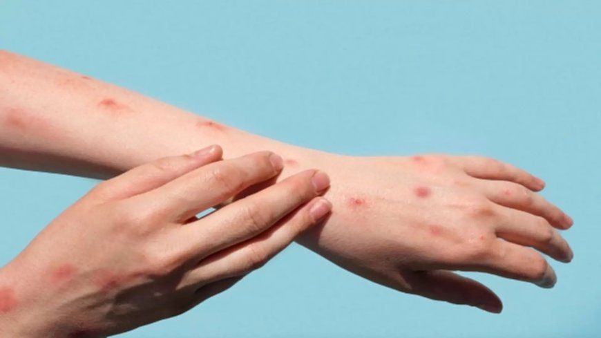 Alerta em Campo Grande: Sesau investiga caso suspeito de mpox e aguarda exames