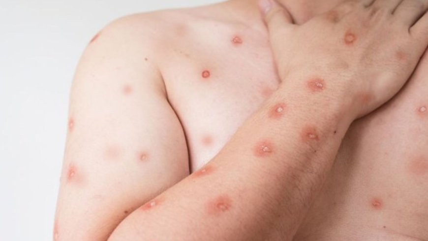 MS registra três casos suspeitos de mpox e SES monitora situação