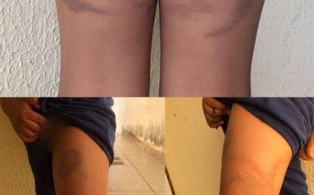 Pai é denunciado por maus-tratos após entregar filho de 7 anos com hematomas à mãe