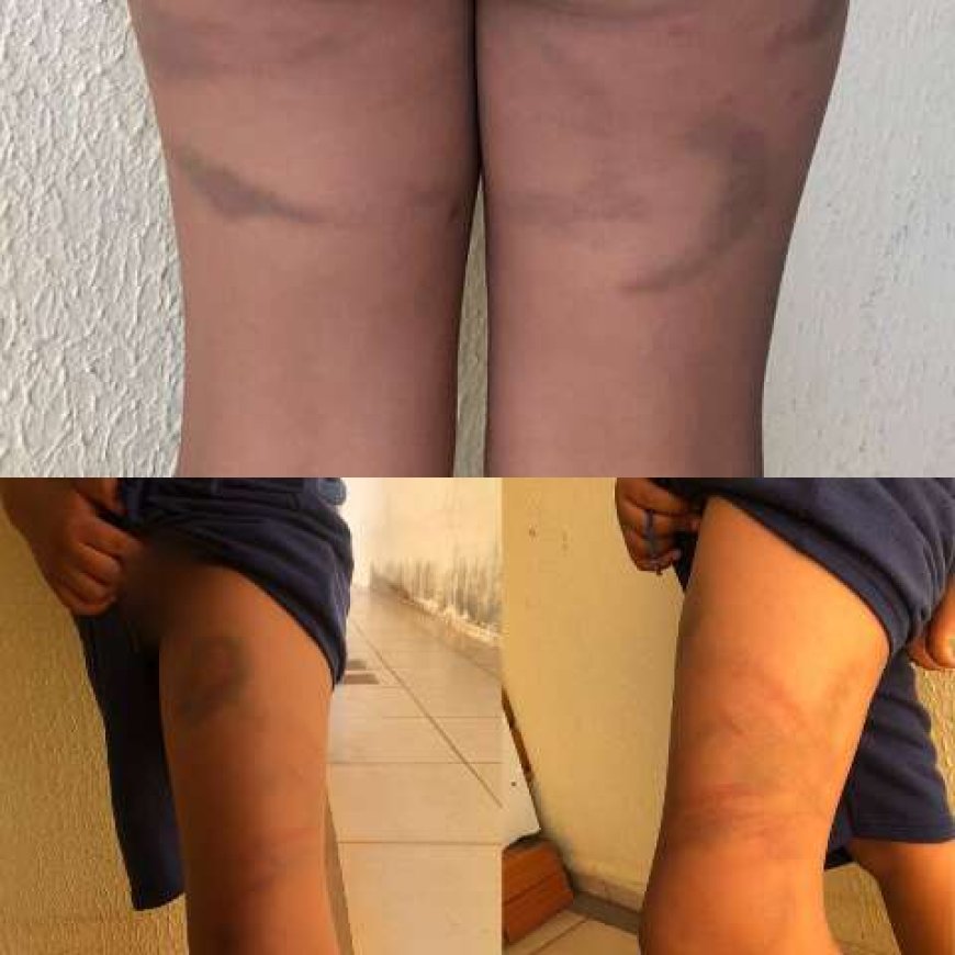 Pai é denunciado por maus-tratos após entregar filho de 7 anos com hematomas à mãe