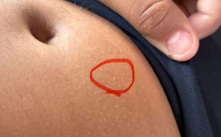 Criança de 11 anos internada após uso de caneta emagrecedora