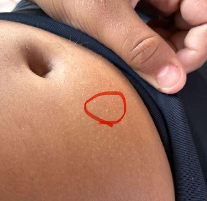 Criança de 11 anos internada após uso de caneta emagrecedora