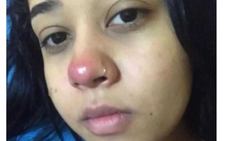 Jovem Fica Paraplégica Após Colocar Piercing no Nariz