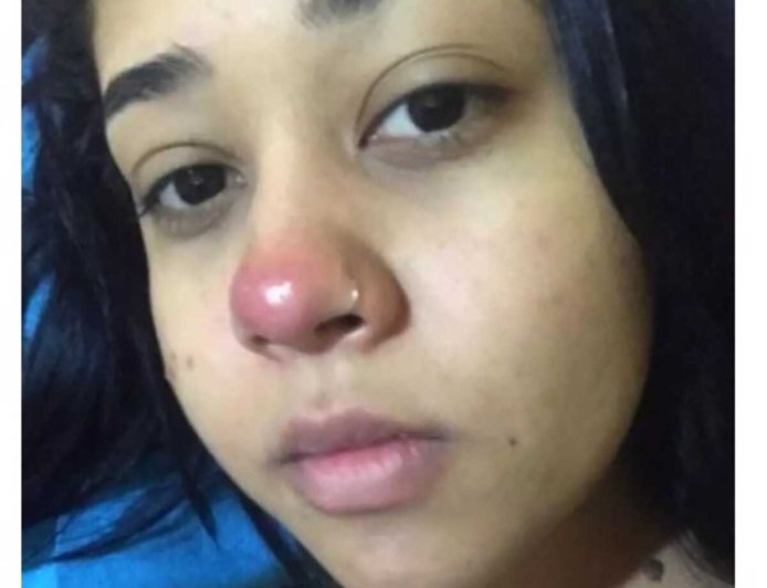 Jovem Fica Paraplégica Após Colocar Piercing no Nariz