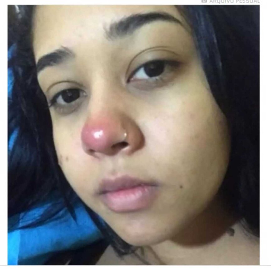Jovem Fica Paraplégica Após Colocar Piercing no Nariz